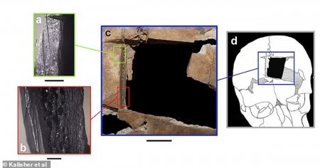 Interventie chirurgicala cranio-cerebrala realizata in urma cu 3.500 de ani. Dovada, descoperita in Israel