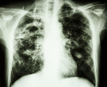 Institutul Marius Nasta avertizeaza privind o crestere majora a numarului de cazuri de turberculoza