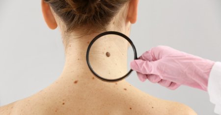 Cele mai importante semne ale cancerului de piele. La ce trebuie sa fii atent