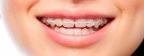 Aparatul dentar fix, solutia ideala pentru rezolvarea problemelor dintilor care se afla pozitionati incorect!