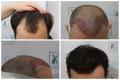 Afla de aici de un implant de par la clinica, Dr Felix Hair Implant te ajuta in acest sens