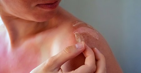 Cancerul de piele, tot mai frecvent. Un risc major il au persoanele care se expun frecvent la soare
