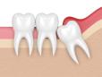<span style='background:#EDF514'>IMPLANTURI</span>le dentare, reduse la o simpla injectie pentru stimularea regenerarii dentitiei naturale