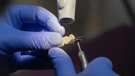 Cat de recomandat este implantul dentar pentru inlocuirea dintilor lipsa? Ce tip de implant ti se potriveste