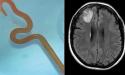 De ce boala suferea femeia in creierul careia a fost gasit un vierme de 8 centimetri