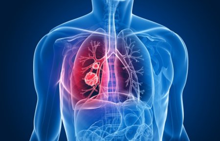 Cancer pulmonar. Un vaccin terapeutic cu rezultate promitatoare