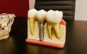 (P) 3 lucruri inedite despre implantul dentar pe care s-ar putea sa nu le stii