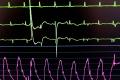O femeie din Anglia a sunat la numarul de urgente din patul de spital pentru ca o asistenta a ignorat <span style='background:#EDF514'>SIMPTOMELE</span> de pe monitorul ei cardiac