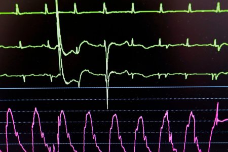 O femeie din Anglia a sunat la numarul de urgente din patul de spital pentru ca o asistenta a ignorat simptomele de pe monitorul ei cardiac