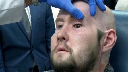 Premiera medicala: Chirurgii au efectuat primul transplant de glob ocular uman din lume la New York