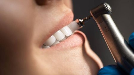 Detartrajul dentar, cea mai eficienta solutie in combaterea placii bacteriene