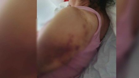 Revoltator! O femeie din Mures dusa la spital cu gripa are acum fracturi la umeri si nu-si poate misca bratele