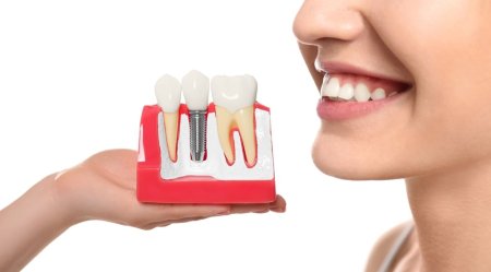 Ce trebuie sa stii inainte de a opta pentru implanturi dentare