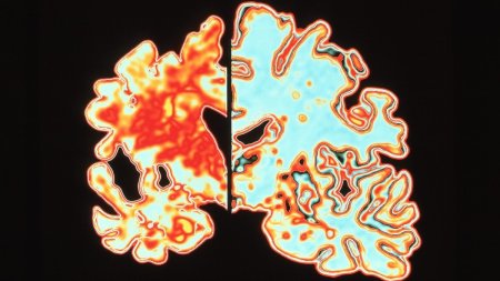 Am ramas cu gura cascata: Un tratament nou pentru Alzheimer, cu ultrasunete, prezinta rezultate uluitoare in testele clinice