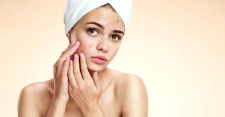 Cum sa scapi de petele de acnee. Top 7 remedii naturiste