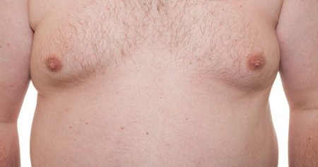 Ce este ginecomastia si cum poti scapa de sanii masculini: Pentru majoritatea barbatilor, problema exista