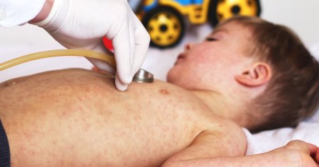 OMS face apel pentru vaccinarea copiilor impotriva rujeolei. Crestere fulminanta a numarului de cazuri in Europa