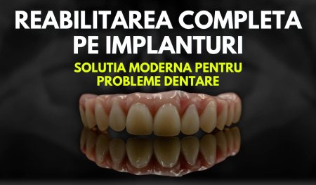 O Solutie Moderna pentru Probleme Dentare: Reabilitarea Completa cu Implanturi