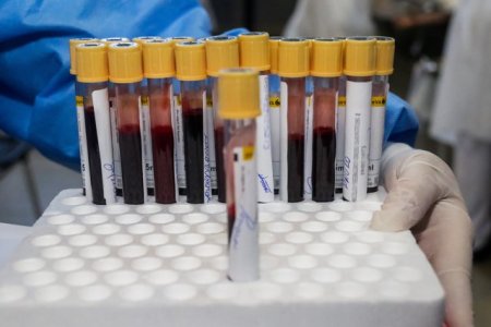 Premiera mondiala: test de sange pentru cancerul cerebral. Poate diagnostica tumorile inaccesibile