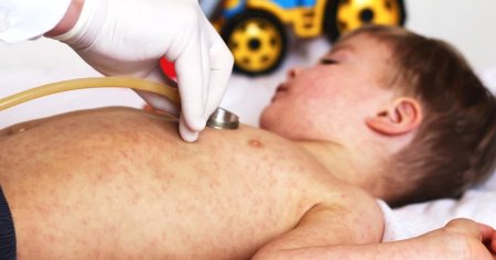 Primul caz de rujeola, dupa ani de inexistenta, in Neamt. Scade constant rata de vaccinare a copiilor