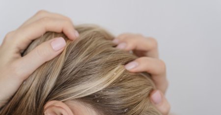 Ingredientul minune care ajuta la evitarea alopeciei, a matretii si a parului gras
