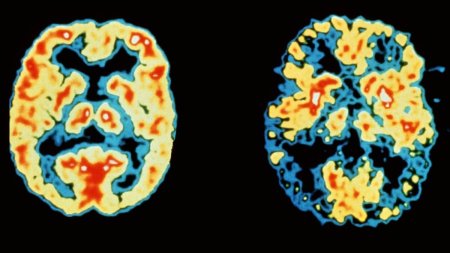 S-a descoperit o noua metoda de a descoperi boala Alzheimer, cu pana la 20 de ani inainte de primele simptome: 