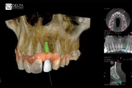 Igiena orala dupa implantul dentar. TOT ce trebuie sa stii