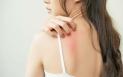 (P) Cum te protejezi de factorii care pot declansa manifestarile dermatitei atopice