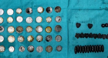 Un culturist indian a inghitit 39 de monede si 37 de magneti, sperand ca zincul o sa-i imbunatateasca performantele. Barbatul a fost operat de <span style='background:#EDF514'>URGENT</span>a