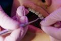 Totul despre aparatul dentar - ce este, beneficii si riscuri