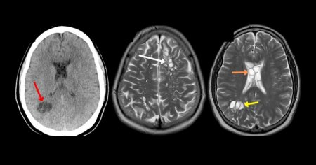 Barbat din SUA, ajuns la spital cu migrena, cauzata de tenii. Alimentul care ar fi fost sursa infectarii