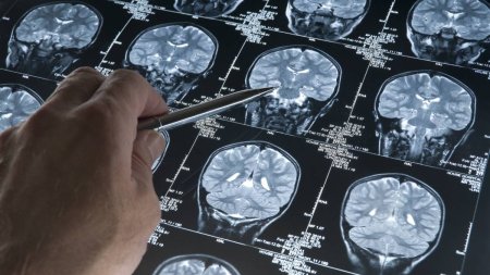 Un barbat care suferea de migrene puternice a descoperit ca avea tenii in creier. Cauza ar fi consumul de slanina insuficient gatita
