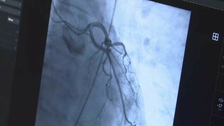 Interventie complicata la Institutul CC Iliescu. Cateter si stent introdus prin vena femurala, inima si artera pulmonara