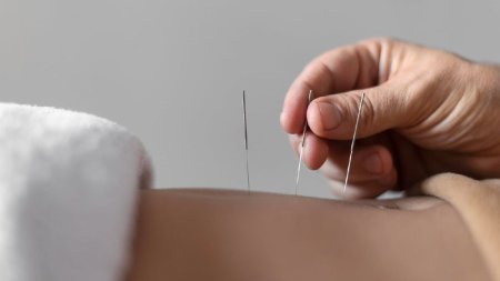 Acupunctura, o metoda terapeutica antica. Beneficii si afectiuni tratate
