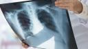 O noua cauza a leziunilor pulmonare descoperita de oameni de stiinta