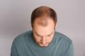 Alopecia – factori de risc, cauze si tratament. De ce chelesc barbatii