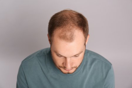 Alopecia – factori de risc, cauze si <span style='background:#EDF514'>TRATAMENT</span>. De ce chelesc barbatii