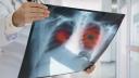 Cresterea cazurilor de <span style='background:#EDF514'>CANCER</span> pulmonar la nefumatori, legata de un gaz radioactiv din aer. Cele mai expuse zone din Romania