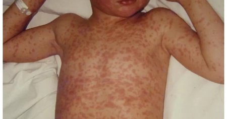 Copil cu rujeola, in stare critica la Terapie Intensiva. Dr Mihai Craiu: Radiografia arata ca la cele mai grave cazuri de infectie SARS-CoV-2