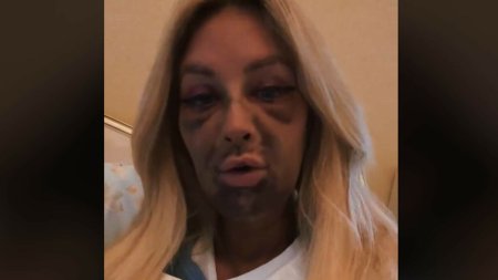 Patania unei femei care a mers sa-si puna implanturi <span style='background:#EDF514'>DENTA</span>re. A ajuns sa arate ca un monstru. VIDEO