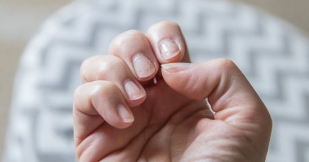 O problema a unghiilor ar putea fi un semn mai putin cunoscut al cancerului