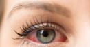 Alergii oculare de <span style='background:#EDF514'>PRIMAVA</span>ra. 