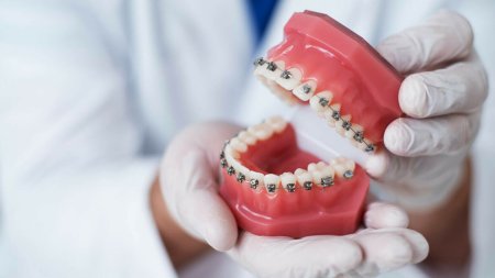 (P) Sfaturi pentru ingrijirea corecta a aparatului dentar