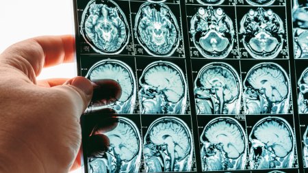 O fata de 19 ani a mers la spital pentru ca avea dureri mari de cap, insa medicii au facut o descoperire socanta
