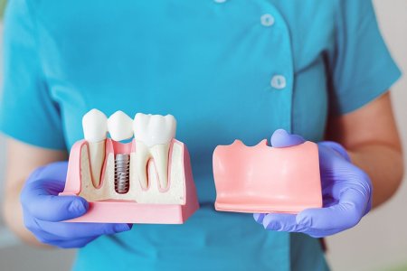 Cum are loc interventia de implant dentar? Care sunt etapele principale?