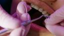 (P) Totul despre aparatul dentar - ce este, beneficii si riscuri
