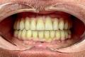Totul despre dinti  ficsi in 24 de ore cu Dr. Grigori Vartolomei