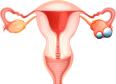 Cancerul ovarian, in crestere! Atentie la simptome!