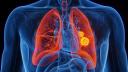 Testul degetelor care poate depista semnele timpurii ale cancerului pulmonar